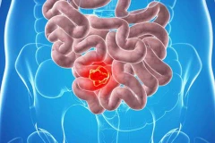 [Video] AI kết hợp công nghệ vũ trụ giúp chống ung thư ruột