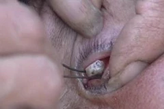 Đá được gắp ra từ mắt. (Nguồn: china.com)