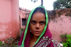 Kamlesh Rathore với chiếc mũi mất chóp. (Nguồn: The Sun)