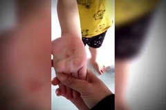 Thực hư việc cô giáo đâm vào tay bé trai 5 tuổi tại Bình Phước?