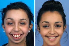 Ellie Jones trước và sau khi trải qua phẫu thuật. (Nguồn: dailymail.co.uk)