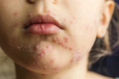 (Nguồn: Cleveland Clinic Health Essentials)