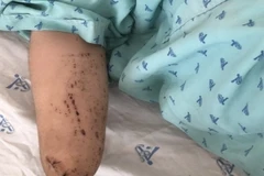 Một bệnh nhân bị đứt lìa bàn tay phải do pháo tự chế nổ. (Ảnh: TTXVN phát)