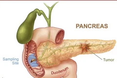Điều trị tiểu đường bằng cách mô phỏng tuyến tụy sinh học