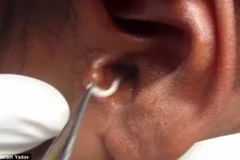 Kịp thời cứu chữa một bệnh nhi bị giòi làm tổ trong lỗ tai 