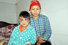 Lào Cai: Buộc thôi việc cô giáo đánh học sinh bầm tím mắt