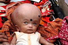 Em bé tội nghiệp bị chứng não úng thủy. (Nguồn: dailymail.co.uk)