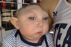 Khi sinh ra Jaxon Emmett Buell bị thiếu mất phần lớn não bộ và hộp sọ. (Nguồn: Daily Mail)