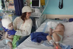 Cặp đôi lập kỳ lục hồi phục sau phẫu thuật tách rời. (Nguồn; Daily Mail)