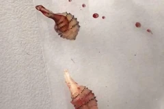 Hai con ấu còn nằm dưới da của cô gái và được bác sỹ gắp ra. (Nguồn: Daily Mail)