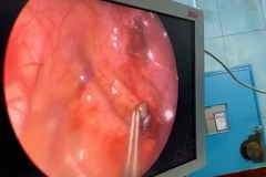 Các bác sỹ gắp viên đạn ra khỏi lồng ngực bệnh nhi bằng phương pháp phẫu thuật nội soi. (Ảnh: TTXVN phát)