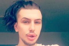 James Holt bơm môi để được giống thần tượng. (Nguồn: AP)