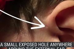 Dị tật có tên là dò luân nhĩ. (Nguồn: Business Insider​)