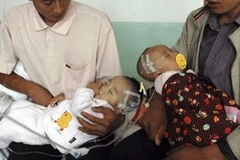 Trẻ em Trung Quốc bị ngộ độc do dùng sữa nhiễm melamin. (Ảnh: Internet)