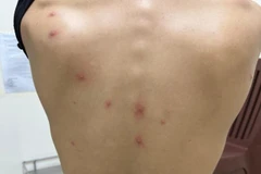 Phát hiện ca bệnh Đậu mùa Khỉ thứ 5 trên địa bàn Thành phố Hồ Chí Minh