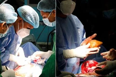 Sri Lanka: Phẫu thuật loại bỏ viên sỏi thận lớn nhất thế giới 