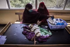 Nhân viên y tế điều trị cho em nhỏ bị suy dinh dưỡng tại bệnh viện ở Mogadishu, Somalia. (Ảnh: AFP/TTXVN)