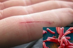 Bệnh vi khuẩn “ăn thịt người” Whitmore. (Nguồn: Bệnh viện Nhi đồng Thành phố Hồ Chí Minh)