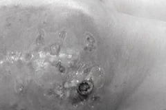 Hoại tử dẫn đến biến dạng cơ thể vì bơm silicon lỏng làm đẹp