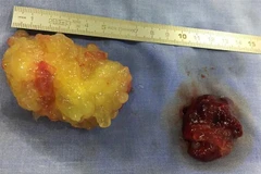 Hai khối u kích thước lớn di động trong tim của bệnh nhân. (Ảnh: Lê Xuân/TTXVN)