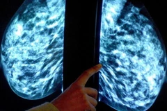 Chụp x-quang xác định bệnh nhân ung thư vú. (Nguồn: Mirror)