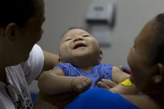 Một trẻ nhỏ bị hội chứng đầu nhỏ. (Nguồn: AP)