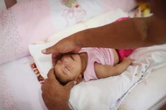 Nhiều trẻ sơ sinh bị dị tật do virus Zika. (Nguồn: AP)