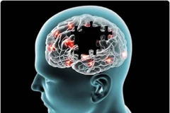 Trung Quốc ghi nhận trường hợp hiếm gặp mắc Alzheimer dù mới 19 tuổi