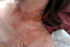 Nguyễn Thị Thuỳ D. đang được điều trị tích cực tại Bệnh viện II Lâm Đồng. (Nguồn: baolamdong.vn)