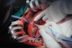 Một ca phẫu thuật ghép gan tại Bệnh viện Chợ Rẫy. (Ảnh: Phương Vy/TTXVN)