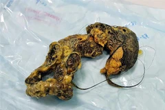 Búi tóc lấy trong bụng bé N. (Ảnh: TTXVN phát)