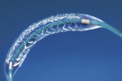 Khuyến cáo mới sau phẫu thuật đặt ống stent nong mạch vành