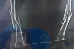 Hình ảnh chụp X-quang cho thấy xương đùi bị gãy sau tập yoga của người phụ nữ. (Nguồn: scmp.com)