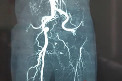 Hình ảnh chụp MSCT mạch máu của ông N. bị tắc. (Ảnh: TTXVN phát)