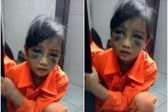 Lào Cai xử lý nghiêm vụ giáo viên đánh học sinh bầm tím mặt