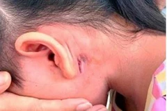 Đắk Lắk lần đầu tiên ghi nhận trường hợp mắc bệnh Whitmore