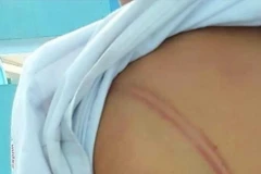 Nhiều vết bầm tím trên người cháu L.M.T được thầy cô giáo phát hiện. (Ảnh: TTXVN phát)