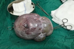 Khối u nặng 4kg trên người phụ nữ 63 tuổi. (Ảnh: Quang Thái/TTXVN)