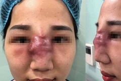 Một trường hợp tai biến do tiêm filler.