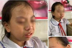 Hình ảnh nữ học sinh lớp 4 Trường Tiểu học Nguyễn Trãi, huyện Bắc Quang (Hà Giang) bị giáo viên tát vào má được người nhà học sinh đưa lên mạng xã hội. (Ảnh: TTXVN)