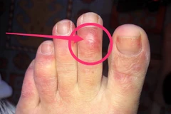 Bệnh nhân COVID-19 bị sưng ngón chân. (Ảnh: Business Insider)