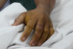 Cứu sống bệnh nhân ngộ độc nặng do đắp thuốc Nam chữa rắn cắn