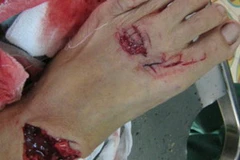 Bị cá dữ tấn công, vết thương trên chân của bà Tánh khá nặng, bị đứt gân góc mu bàn chân trái. (Nguồn: Internet)