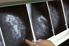 Phim chụp trường hợp bị ung thư vú. ảnh minh họa. (Nguồn: dinhduong.com.vn)