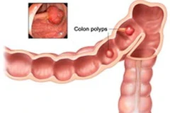 Ung thư ruột kết. (Nguồn: Internet)