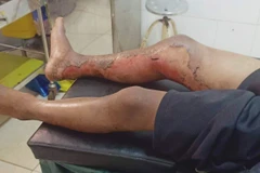 Thông tin thêm về vụ cháu bé 8 tuổi bị bỏng xăng ở Đắk Lắk