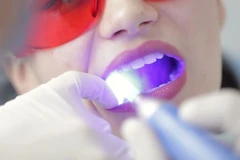 Bước tiến mới trong phát triển vật liệu điều trị nha khoa