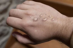 Singapore xác nhận một ca bệnh đậu mùa khỉ 'nhập cảnh'