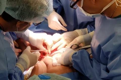 Các bác sỹ đang phẫu thuật tách rời hai bệnh nhi song sinh dính nhau. (Ảnh: TTXVN phát)