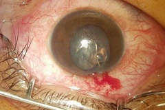 Dị vật trong mắt bệnh nhân. (Ảnh: Trần Ánh Dương/TTXVN phát)